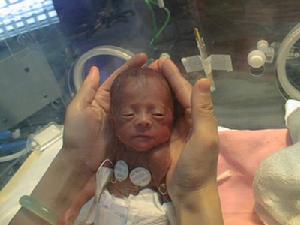 新生兒呼吸暫停