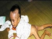 小兒皺梅腹綜合徵 小兒皺梅腹綜合徵