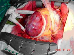 胸主動脈夾層動脈瘤