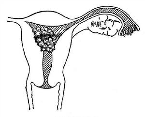子宮頸肉瘤 子宮頸肉瘤