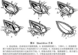成人腹股溝斜疝