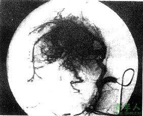 肝纖維板層癌 肝纖維板層癌