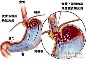 返流性食管炎 返流性食管炎