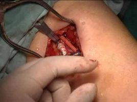 動靜脈外瘺術 動靜脈外瘺術