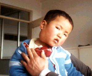 頸部囊狀淋巴管瘤