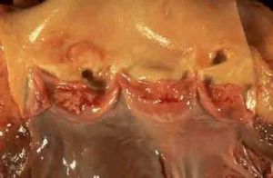 亞急性細菌性心內膜炎 亞急性細菌性心內膜炎