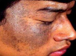 藍色藍灰色或藍黑色丘疹 藍色藍灰色或藍黑色丘疹