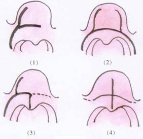鼻咽血管纖維瘤