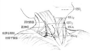 頸部淋巴結切除術
