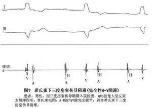 完全性房室傳導阻滯