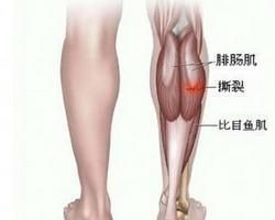 腓腸肌痙攣 腓腸肌痙攣