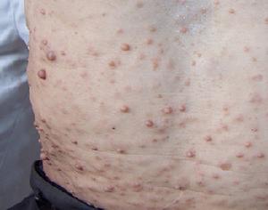 多發性神經纖維瘤