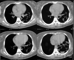 先天性支氣管肺囊腫