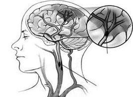 頸髓脫髓鞘性病變 頸髓脫髓鞘性病變