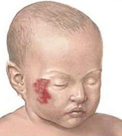 斯特奇-韋伯綜合徵 斯特奇-韋伯綜合徵