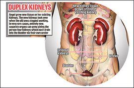 重複腎 重複腎