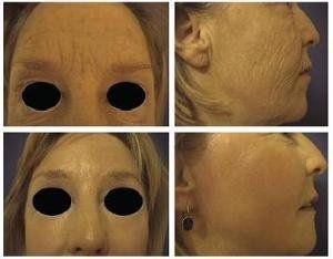 須部假毛囊炎 須部假毛囊炎