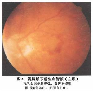 視網膜下新生血管膜