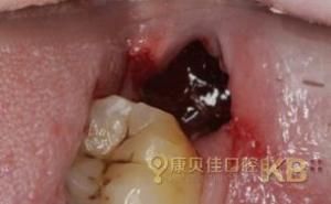 拔牙出血