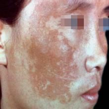 治蝴蝶斑藥膳方 治蝴蝶斑藥膳方