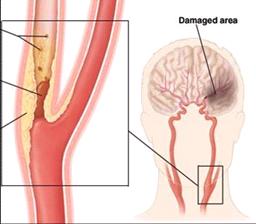 急性缺血性腦血管病