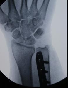 尺骨撞擊綜合症 尺骨撞擊綜合症