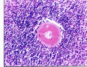 原發性巨球蛋白血症腎損害