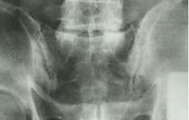 骶髂部劇烈疼痛 骶髂部劇烈疼痛