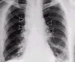 （圖）肺炭疽