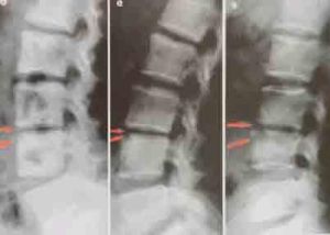 化膿性脊柱炎 化膿性脊柱炎