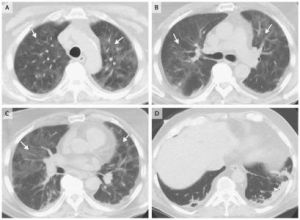 慢性嗜酸性粒細胞性肺炎 慢性嗜酸性粒細胞性肺炎