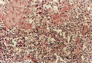 類鼻疽桿菌肺炎