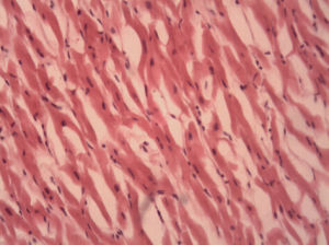 心肌脂肪變性 心肌脂肪變性