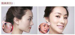黃金龍隆鼻案例