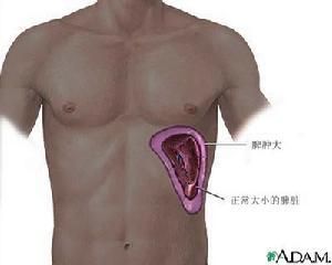 脾膿腫 脾膿腫