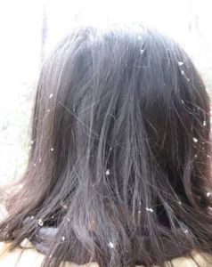 頭屑 頭屑