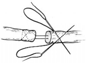 肌腱縫合術 肌腱縫合術