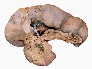 急性化膿性乳突炎