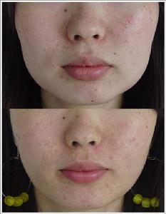 複雜鼻尖整形術