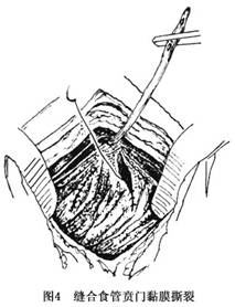 賁門黏膜撕裂綜合徵