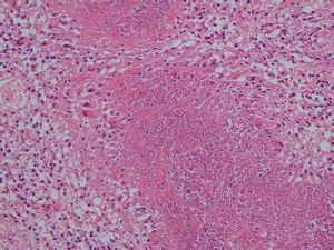 股臀皮膚血管炎