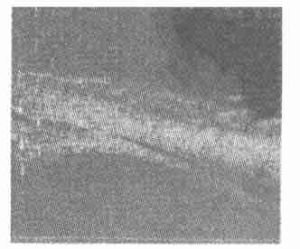 原發性急性閉角型青光眼