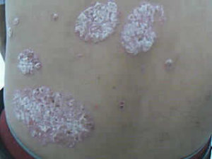 血虛型牛皮癬 血虛型牛皮癬