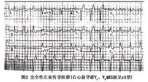 左束支傳導阻滯