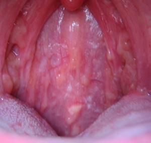 聲帶肥厚 聲帶肥厚