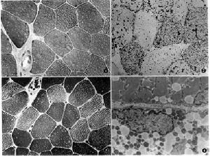 脂質沉積性肌病