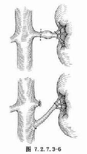 脾腎動脈吻合術 脾腎動脈吻合術