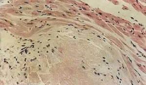 心肌糖原積累症 心肌糖原積累症