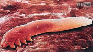 毛囊蠕形蟎 毛囊蠕形蟎