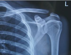 肩鎖關節脫位 肩鎖關節脫位